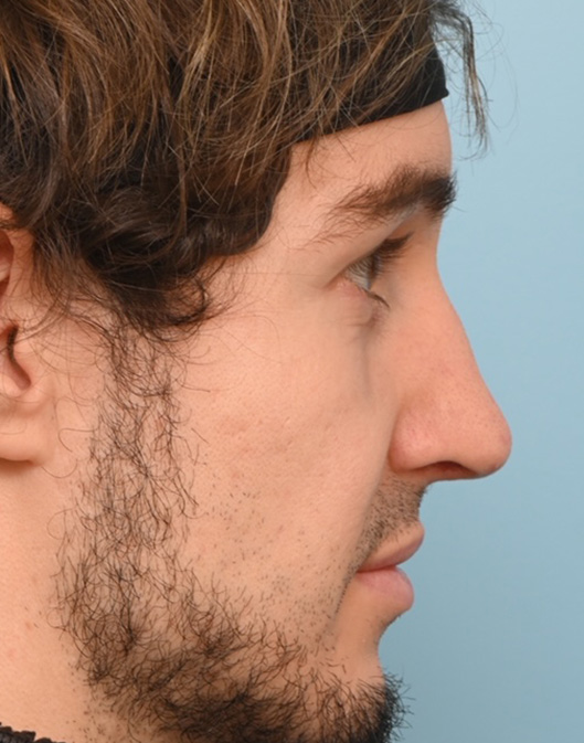 Rhinoplasty