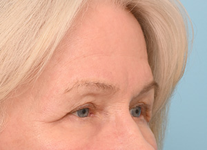 Brow Lift