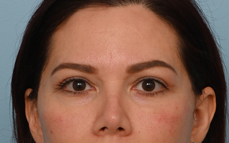 Eye Rejuvenation