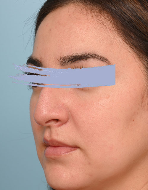 Rhinoplasty