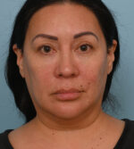 Face Lift/Neck Lift