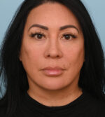 Face Lift/Neck Lift