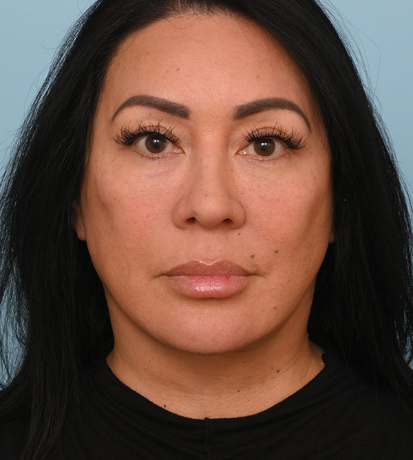 Face Lift/Neck Lift
