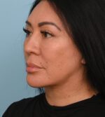 Face Lift/Neck Lift