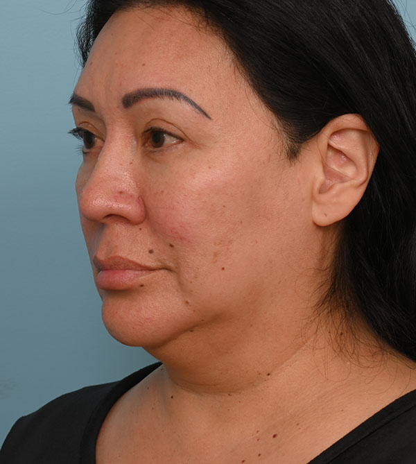 Face Lift/Neck Lift
