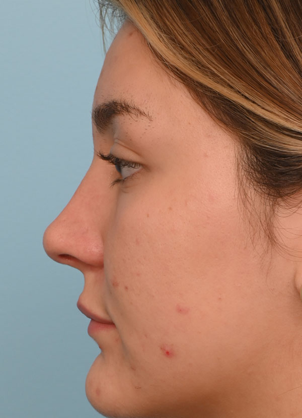 Rhinoplasty