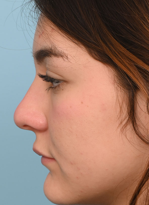 Rhinoplasty