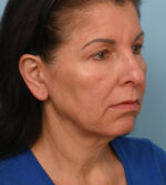 Face Lift/Neck Lift