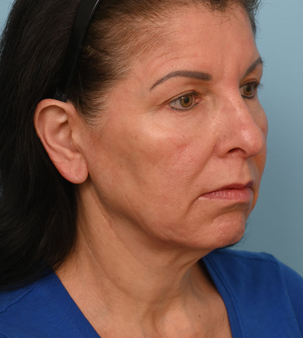 Face Lift/Neck Lift