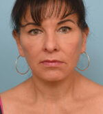 Face Lift/Neck Lift