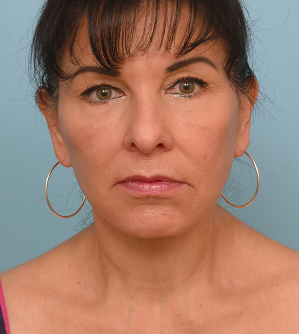 Face Lift/Neck Lift