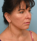 Face Lift/Neck Lift