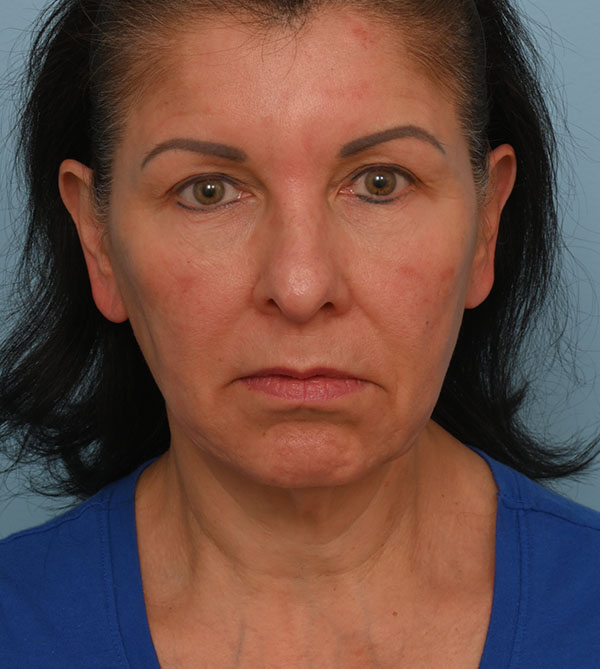 Face Lift/Neck Lift