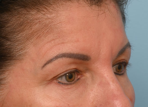 Brow Lift