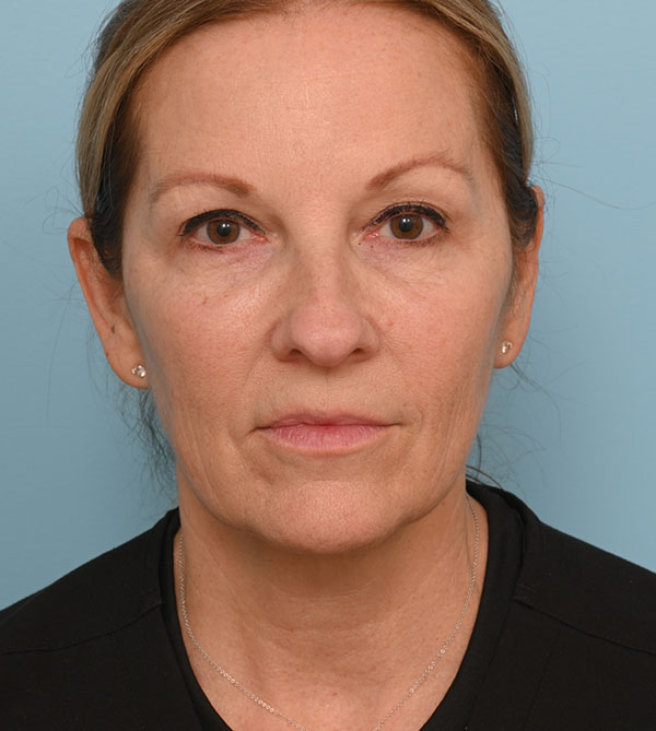 Face Lift/ Mini Lift/ Neck Lift