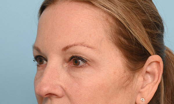 Eye Rejuvenation