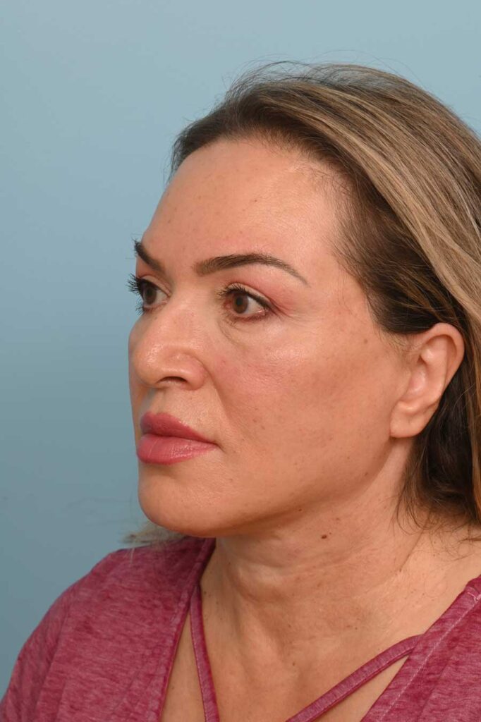 Face Lift/Neck Lift