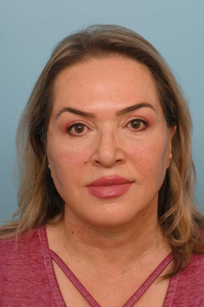 Face Lift/Neck Lift