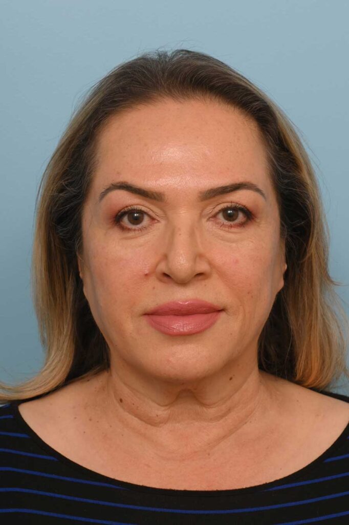 Face Lift/Neck Lift