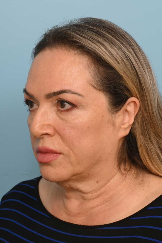 Face Lift/Neck Lift