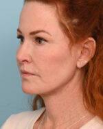 Face Lift/Neck Lift