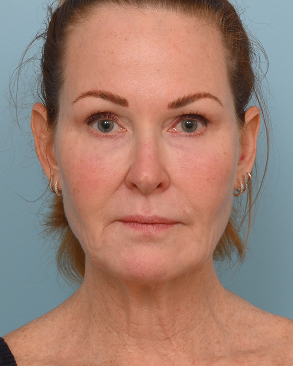 Face Lift/Neck Lift