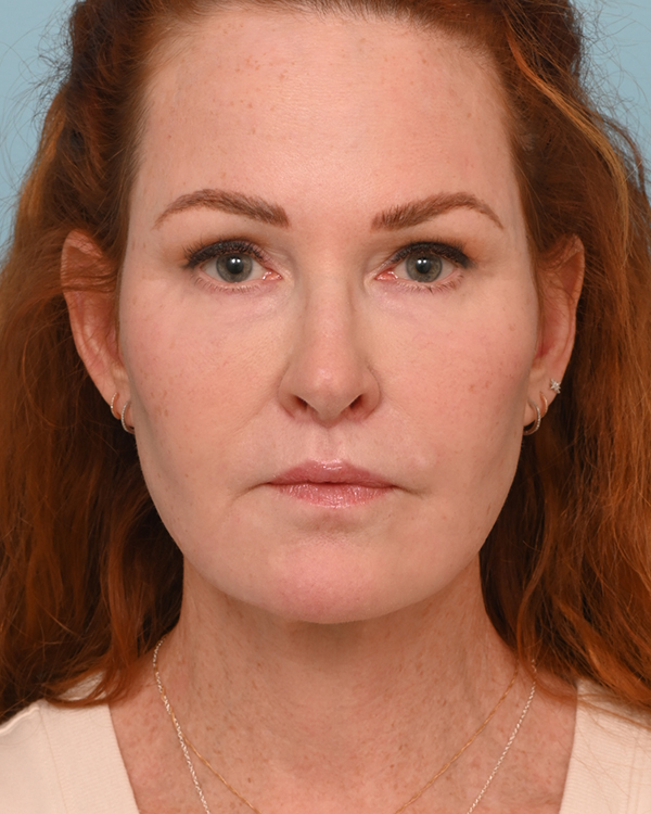 Face Lift/Neck Lift