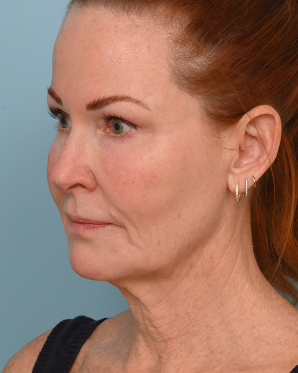 Face Lift/Neck Lift