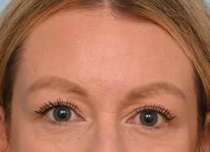 Brow Lift