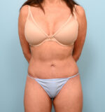 Body Liposuction