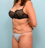 Tummy Tuck