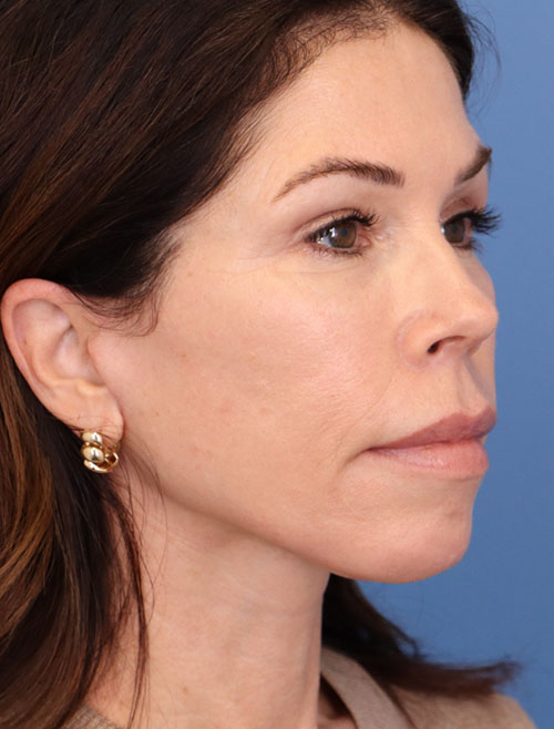 Face Lift/Neck Lift
