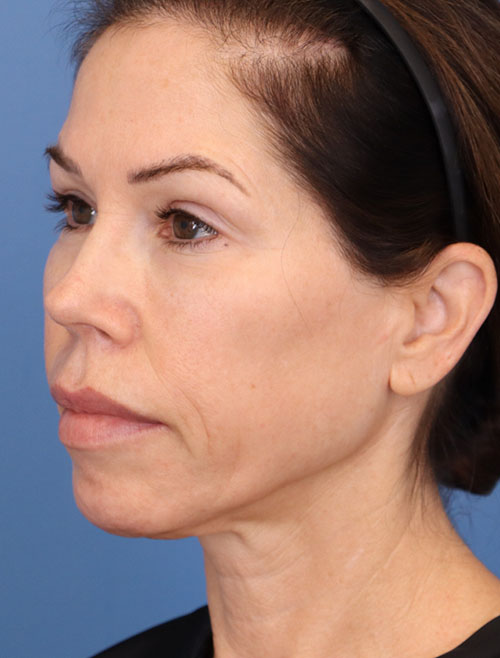 Face Lift/Neck Lift