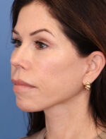 Face Lift/Neck Lift
