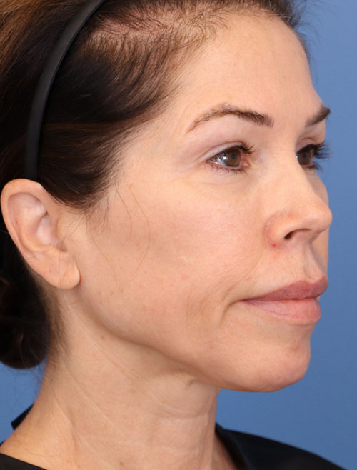Face Lift/Neck Lift