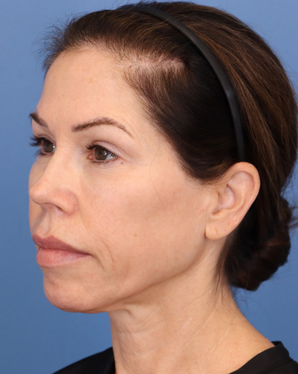 Facial Fat Transfer