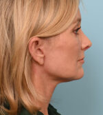 Face Lift/ Mini Lift/ Neck Lift