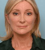 Face Lift/Neck Lift