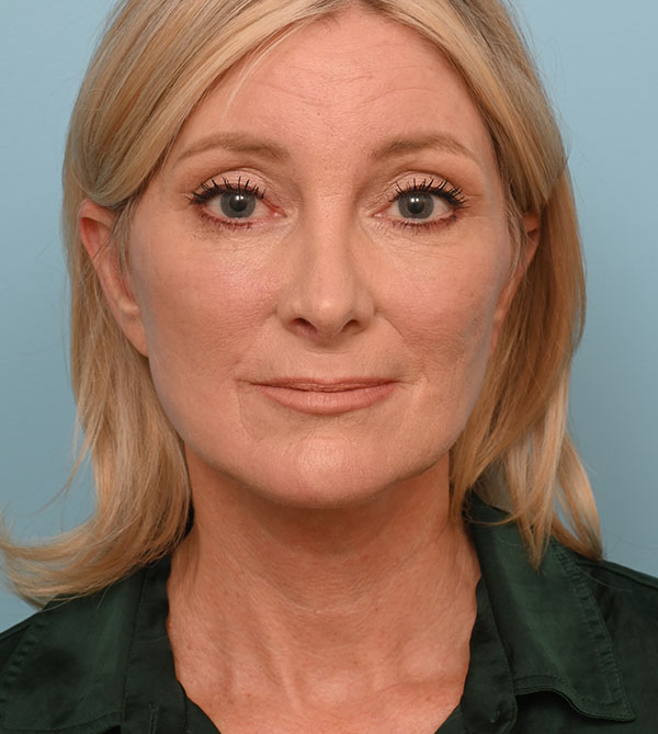 Face Lift/Neck Lift