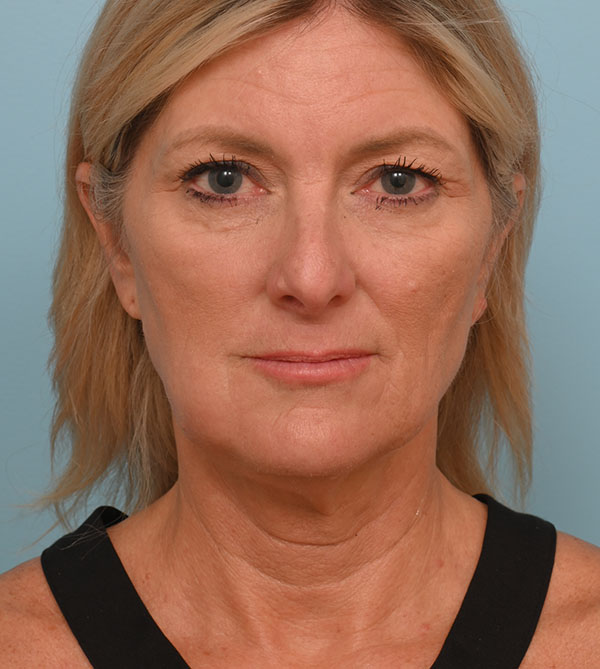 Face Lift/Neck Lift