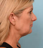 Face Lift/ Mini Lift/ Neck Lift