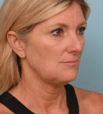 Face Lift/Neck Lift