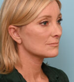 Face Lift/Neck Lift