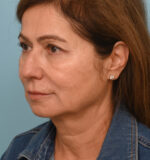 Face Lift/Neck Lift
