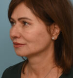 Face Lift/Neck Lift