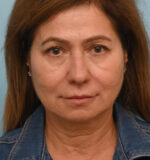 Face Lift/Neck Lift