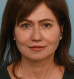 Face Lift/Neck Lift