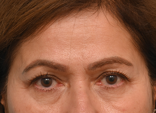 Brow Lift