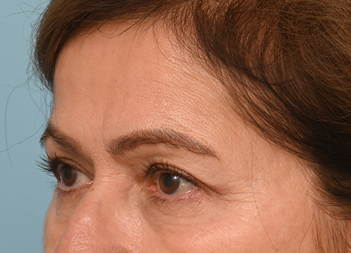 Brow Lift