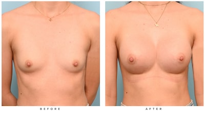 Breast Augmentation Before and After | Dr. Tyler Frew MD